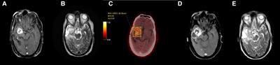 The complementary role of MRI and FET PET in high grade gliomas to differentiate recurrence from radionecrosis